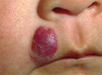 hemangiomas.jpg