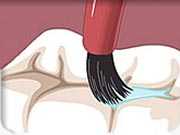 sellador-dental.jpg